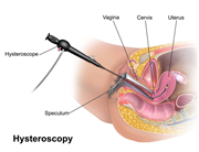 Affordable Hysteroscopy in Mumbai at Dr. Ankita Fertility Center