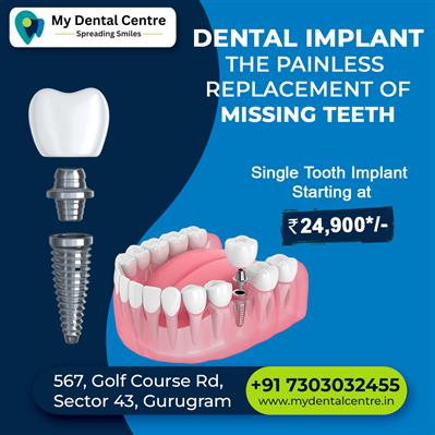 Single Teeth Implant Starting at 24900*