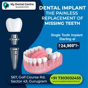 Single Teeth Implant Starting at 24900*