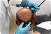 Best Hair Transplantation In Hyderabad